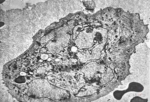 F,16y. | bone marrow - malignant histiocytosis F,16y. | bone marrow - malignant histiocytosis